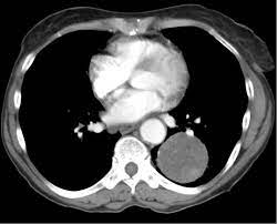 It is considered a developmental error and can occur at a number of sites. Pulmonary Hamartoma Pulmonology