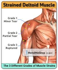 Inserts onto navicular tuberosity and first cuneiform. Deltoid Strain