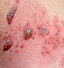 Image result for Skin Infection