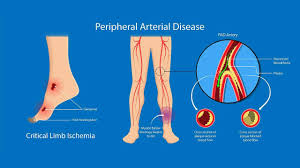 Image result for toe amputation