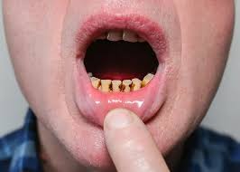 Image result for Tooth Avulsion