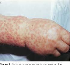 Image result for Papular Acrodermatitis