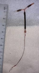 Intrauterine device (iud) with copper, also known as intrauterine coil, is a type of intrauterine device which contains copper. File Copper Iud Jpg Wikimedia Commons