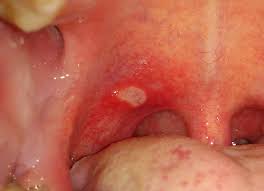 Cankers are often extremely painful, especially when agitated. Canker Sore Treatments Causes And Symptoms