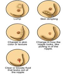 This team often consists of cancer specialists, as. Physical Signs Of Possible Breast Cancer Download Scientific Diagram