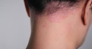 Image result for Psoriasis