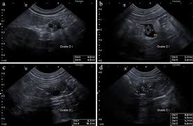 Image result for corpus luteum sonography)