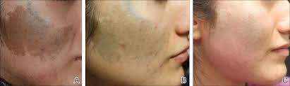 Successful Treatment Of Ota Nevus With The 532 Nm Solid State Picosecond Laser Mdedge Dermatology