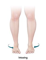 Image result for In-Toeing