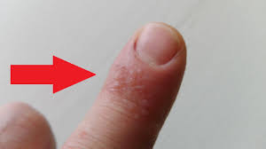 Articole relevante pentru cautarea bubite pe talpi la copii. Ce InseamnÄƒ DacÄƒ Ai Aceste Puncte Pe Piele Ai Putea Suferi De DishidrozÄƒ Antena 1