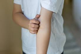 See full list on wikihow.com How To Treat Scabies Drgreene Com