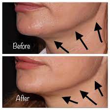 We did not find results for: Nefertiti Lift Reduce Jowls And Contour Your Jawline With Botox Jennifer Moller Ms Pa C Newport Beach Dermatology Plastic Surgery