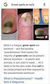 You'll know you're infected with pseudomonas when you see a strange green or grey stain on or under your nails. Facebook
