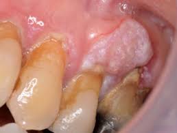 Mouth cancer means cancer cells form on the lips or in the mouth or throat. Oral Cancer Dermnet Nz