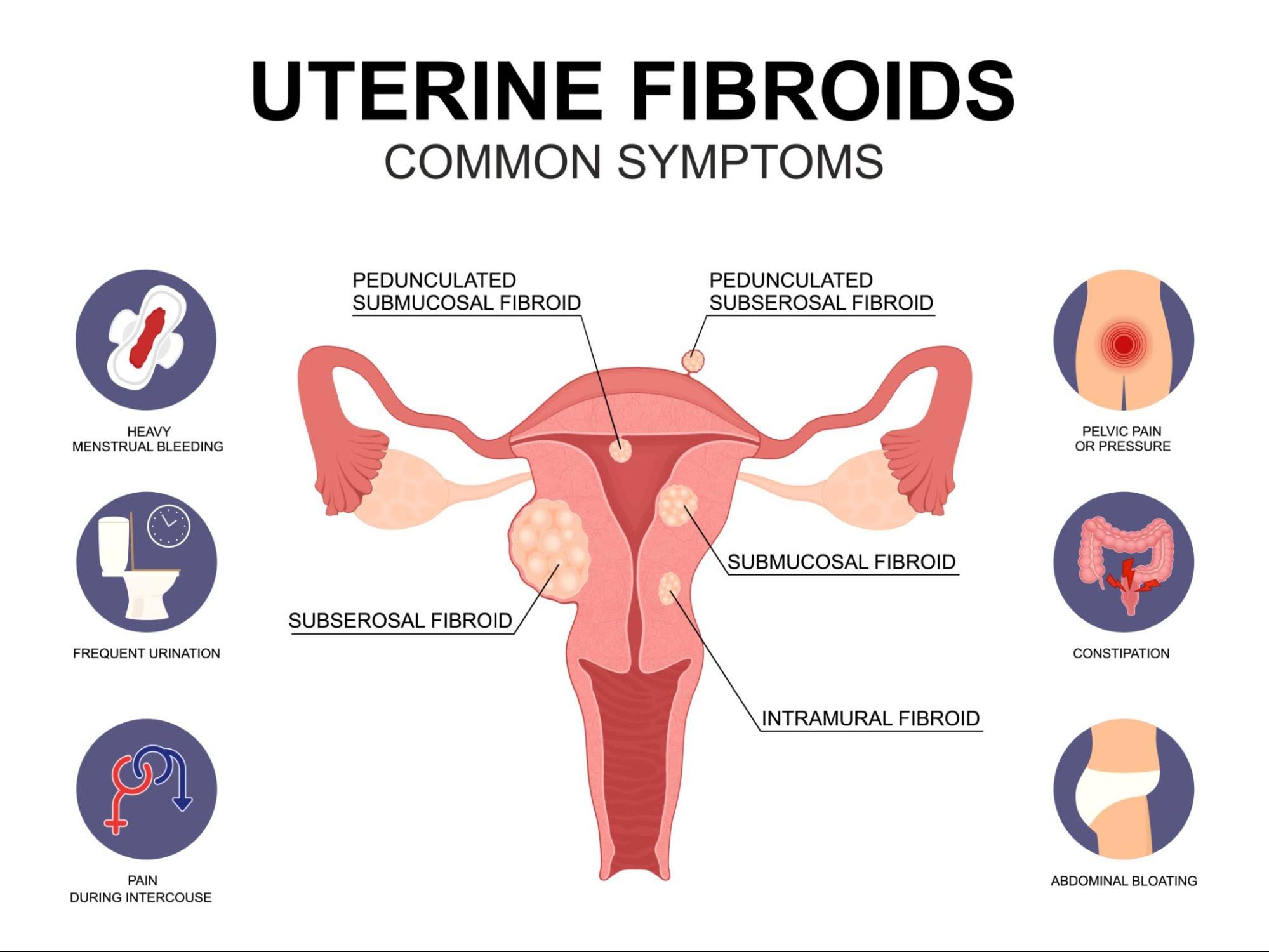 Heavy menstrual bleeding hysterectomy product image
