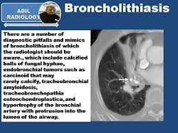 Image result for Broncholithiasis