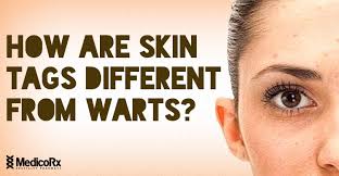 Melanoma — a serious form of skin cancer — is often curable if you find it early. How Are Skin Tags Different From Warts Medicorx