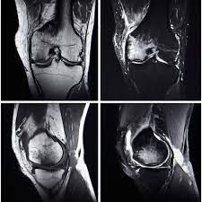 Knirschen Im Knie Wie Schlimm Ist Es Wirklich Felixkade De
