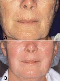 Cutaneous laser resurfacing