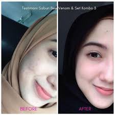 Physicians report good results using the substance to treat not. Offer Pkp Secretleaf Skincare Kombo3 Hapus Jeragat Dan Parut Jerawat 3 In 1 Free Gift Shopee Malaysia