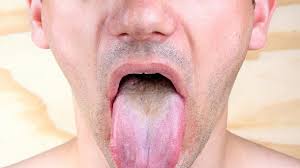 Schauen wir uns die unterschiedlichen arten von pickeln auf der zunge näher an. Mundkrankheiten Sieben Fiese Leiden An Zunge Mundschleimhaut Und Zahnfleisch