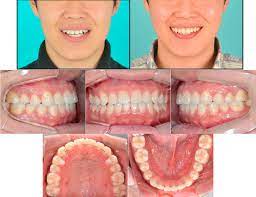 References In Maxillary Transverse Expansion In Adults Rationale Appliance Design And Treatment Outcomes Seminars In Orthodontics