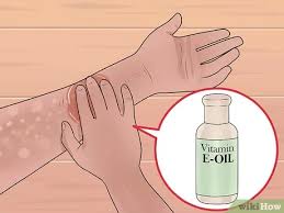 White spots on legs and white spots on your arms are also called idiopathic guttate hypomelanosis. How To Get Rid Of White Spots On The Skin Due To Sun Poisoning