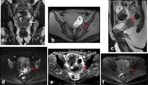 Why is this tool useful? Role Of Mri In Staging And Follow Up Of Endometrial And Cervical Cancer Pitfalls And Mimickers Insights Into Imaging Full Text