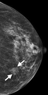 Not all women have calcifications in their breasts—but most do. Interpreting One View Mammographic Findings Minimizing Callbacks While Maximizing Cancer Detection Radiographics
