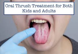 Image result for oral thrush symptoms roof of the mouth