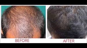The hair loss a person with telogen effluvium experiences also happens to be reversible, meaning that most people with the condition do see their hair come back. Juicing Grow My Hair Back Hair Loss Due To Dht Reversible Youtube