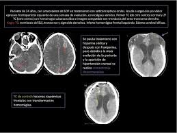 Find what is a thrombosis Revision De La Trombosis Venosa Cerebral Diagnostico Tratamiento Y Evolucion Clinicoradiologica Semantic Scholar