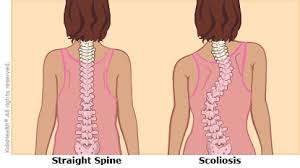 Scoliosis Illustration Scoliosis Types Of Surgery Types Of Braces