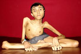 Image result for Muscular Dystrophy