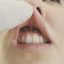 smiley piercing amazing photos and important information tats n rings mouth piercings smiley piercing ear piercings