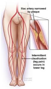Poor circulation in legs pictures. Symptoms Of Poor Peripheral Circulation Schedule A Pad Screening