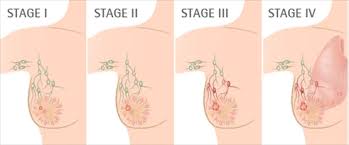 Image result for Inflammatory breast cancer