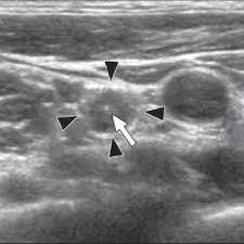 Two in three cases of thyroid cancer occur in people under age 55, and 75%. Year Old Woman With Level Iv Metastatic Lymph Nodes In Right Neck Download Scientific Diagram