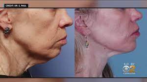 Laser treatment some lasers can send heat deep into the skin without wounding the top layer of your skin. Tightening The Skin Without Surgery Youtube