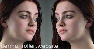 قبل وبعد الديرما رولر Derma Roller Roller