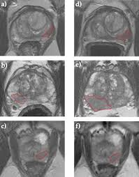 Here are 10 more facts about prostate cancer. Mri Derived Radiomics Model For Baseline Prediction Of Prostate Cancer Progression On Active Surveillance Scientific Reports