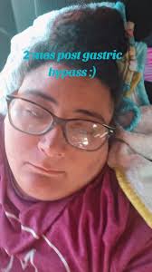 best decision made! #fyp #gastricbypass