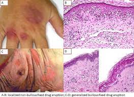 Abstracts From The 8th Drug Hypersensitivity Meeting Dhm Clinical And Translational Allergy Full Text