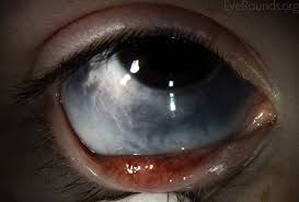 Image result for lesion sclera