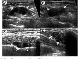 It can occur at any age (and, extremely rarely, in men). Sonographic Features Of Inflammatory Breast Cancer Semantic Scholar