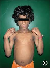 Image result for Lipodystrophy