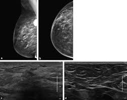 Inflammatory breast cancer (ibc) this is a less common type of breast cancer. Imaging Inflammatory Breast Cancer Sciencedirect