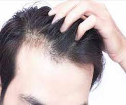 Since thinning hair is a chemical problem, there are chemical solutions. Researchers Find Novel Solution To Prevent Baldness