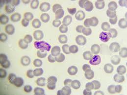 The parasites are spread to people through the bites of any one of the following criteria along with a positive blood smear for the parasite p. Malaria Parasite In Blood Smear Plasmodium Vivax Stock Photo Picture And Royalty Free Image Image 56968595