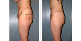 Each is entitled to their opinion but if bashing is what you wan. Surgery After Massive Weight Loss Before And After Photos Usha Rajagopal Md